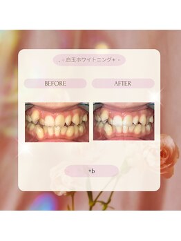 プラスビー 2号店(+b)/ホワイトニングビフォーアフター
