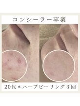 サロンドペシェ(salon de peche)/20代＊ハーブピーリング３回