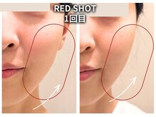 エトワール(etoile)/RED SHOT/小顔.天王寺あべの痩身