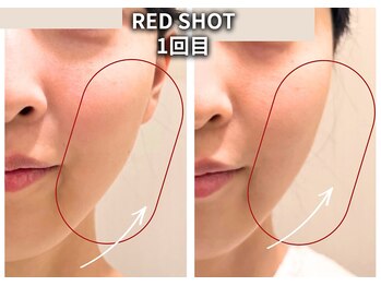 エトワール(etoile)/RED SHOT/小顔.天王寺あべの痩身