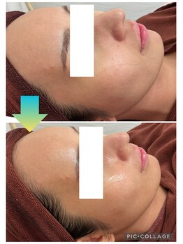 エスビーエス オキナワ(SBS OKINAWA)/毛穴洗浄