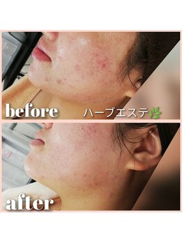 エクラ(eclat)/ハーブエステ