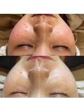 ラウレア(LAULEA)/肌荒れ改善