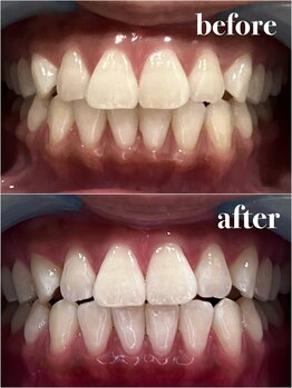 レヴィオ(Revio_)/セルフホワイトニング