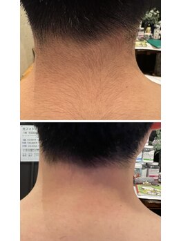 ママナ(mamana)/メンズうなじ脱毛が人気!