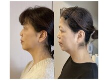 小顔22 ボルティ 本店(Bolty)/50代：小顔シンメトリー（4回）