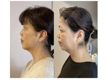 小顔22 ボルティ 本店(Bolty)/50代:小顔シンメトリー(4回)