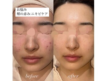 ウー バイ ルーヴェ(ou by Luve)/陶肌トリートメント