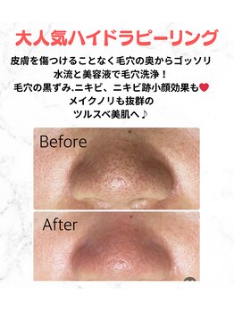 ルアナ(Ruana)/毛穴ケアハイドラピーリング