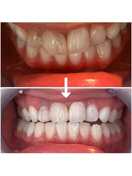 エクシアホワイトニング 代々木店/ビフォーアフター　代々木/新宿