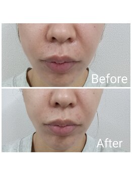 レン(Ren)/ラテスパ<毛穴洗浄/くすみケア>