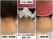 プレヴェール 神戸三宮/うなじ脱毛