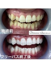 ホワイトニングサロン 京都烏丸店/ホワイトニング施術例