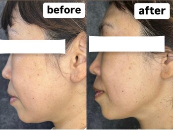 ラローズ(La Rose)/韓国シワたるみケア★サーマガン