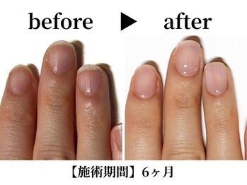 リング ザ ベル(ring the bell)/深爪スタンダードコース¥11,000