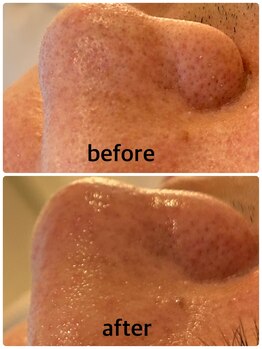 マナ(mana)/大阪 梅田 毛穴洗浄フェイシャル