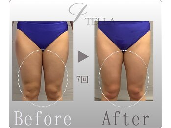 ステラ(STELLA)/下半身プレミアムの効果