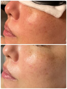 ルアナライフ(Luana Life)/BBLフェイシャル1回 40代