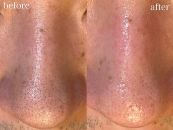 アワピール 天王寺店(AWA PEELL)/毛穴洗浄/天王寺/毛穴洗浄/小顔