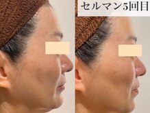 セレブリボーン 大阪ボーテ/セルマンピーリング