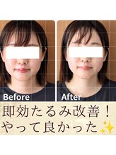 スウ(suu.)/Before-After【30代】1回
