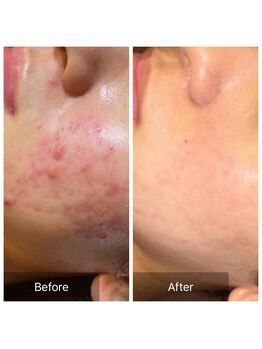 ディーキャットリー(D Catrry)/ハーブピーリング