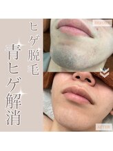 髭ラボ(髭LABO)/ヒゲ脱毛☆青ヒゲ解消