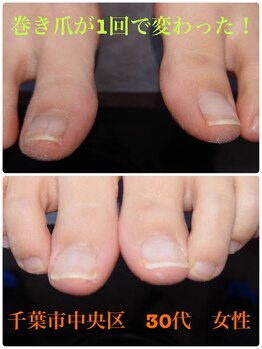 巻き爪じゅん 千葉駅前店/巻き爪1回で良くなくなった！