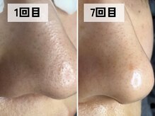 エアル(earu.)/BA|毛穴ケア|ピーリング|高円寺