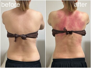 ミミ(MIMI)/背中1面トリートメント