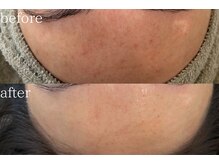 唯一無二のハープピーリングで大人女性の肌質改善/細胞美容