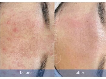 ハーシークレット(Her secret)/ダクトピール+毛穴洗浄