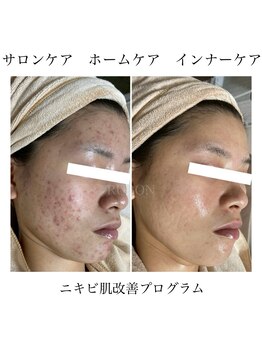 ルボン 宮崎店(RUBON)/RUBONの本気の肌質改善！