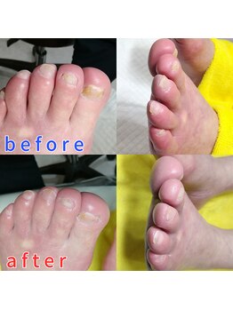 【肥厚・変形爪】ネイル/フット
