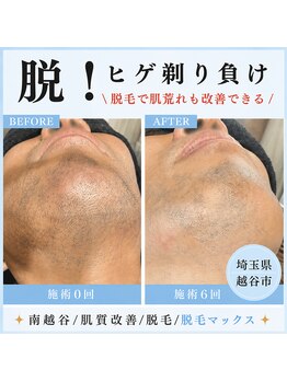 脱毛マックス 南越谷店(MAX)の写真/もう髭剃りに悩まない！剃刀負けを卒業し、清潔感あふれる肌を手に入れよう◎