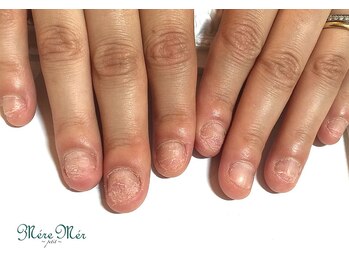 メールメール 和光市本店(MereMer)/(開始)113 深爪 深爪緩和 ケア　