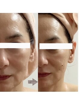 メディカルサロン かとれあ/スーパーリフト