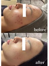 スピカ(Spica) にきびケア 得意です☆