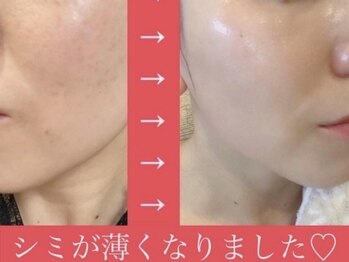 ビ ボーテ(美 Beaute)/シミ根本改善★メニュー