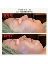 ボディケアサロン アイリフ(airef)/ビフォーアフター