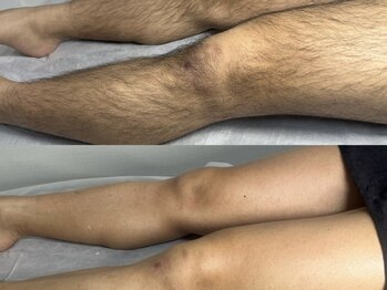 ミルダ(MIRUDA)/メンズ／足のビフォーアフター