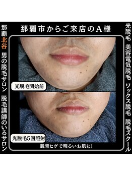 ディースタイル 北谷店(Dstyle)/北谷メンズ脱毛ヒゲBefore after