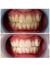 エンコロレ(encolore)/《クリスタルホワイトニング》