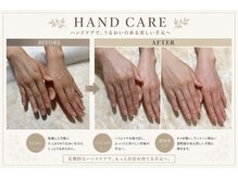 ハンナ(HanNa)/ハンドケア|症例写真