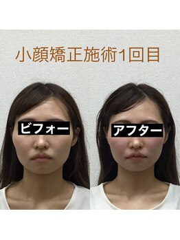 オズ六本木/六本木小顔矯正(造顔)施術1回