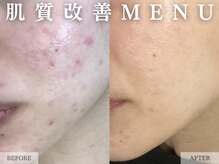 レヴェリー 心斎橋店(REVERIE)/肌質改善コース