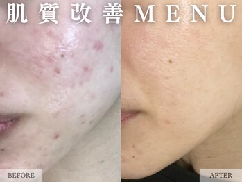 レヴェリー 心斎橋店(REVERIE)/肌質改善コース