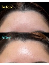 ノエル(Noel)/潤いツヤおでこ