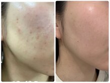 美人バスト 浜松店/韓国肌が叶う★ハーブピーリング