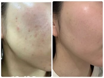 美人バスト 浜松店/韓国肌が叶う★ハーブピーリング